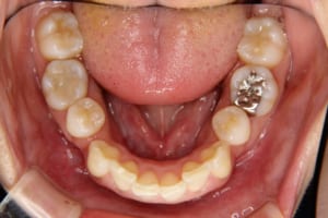 他院での矯正歯科治療時に小臼歯抜去済み